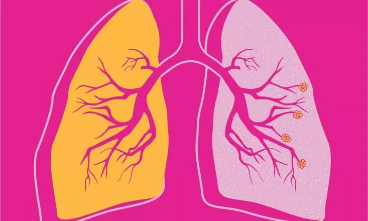 Living with chronic inflammatory lung disease