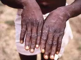 Monkeypox is contagious up to four weeks after the first symptom: experts