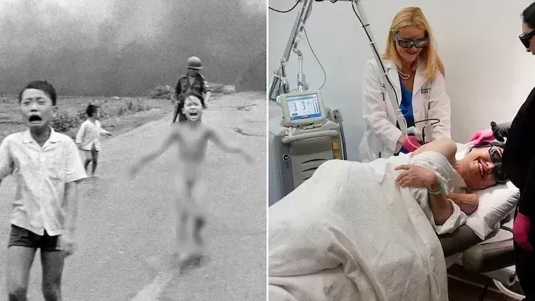 Iconic Napalm girl gets final skin treatment in US
