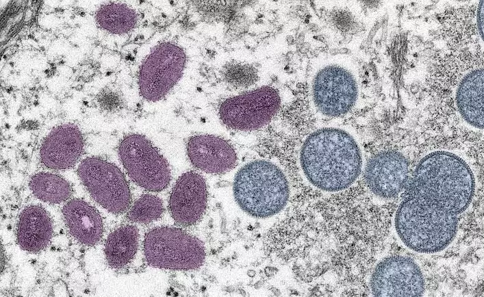 Studies underway to see if mutations behind spread of monkeypox: WHO
