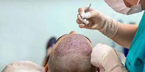 Mushrooming hair transplant clinics call for regulation: report