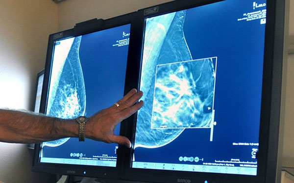 Relatives with prostate cancer ups breast cancer risk in women